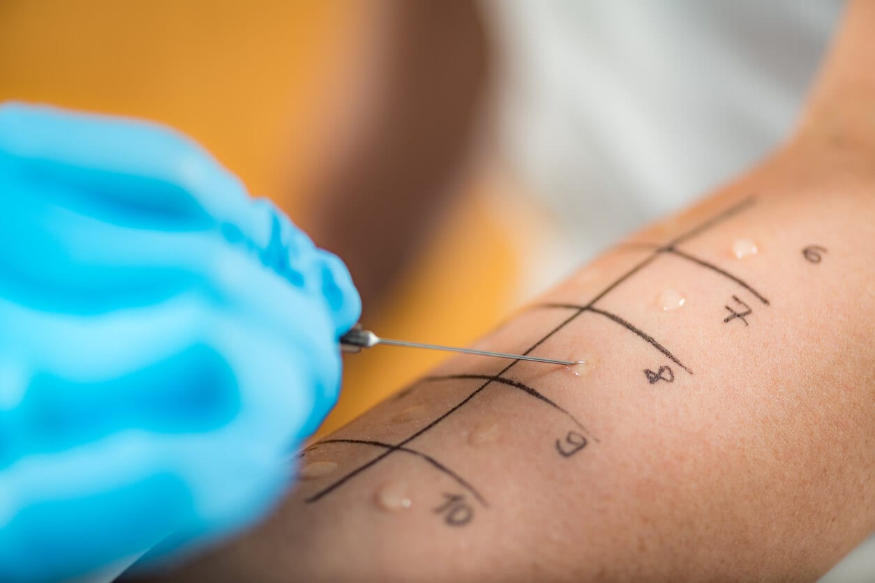 Allergy Testing
